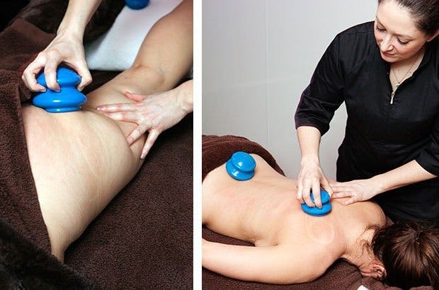 Tara tester kopping for å redusere cellulitter: Kopping mot cellulitter